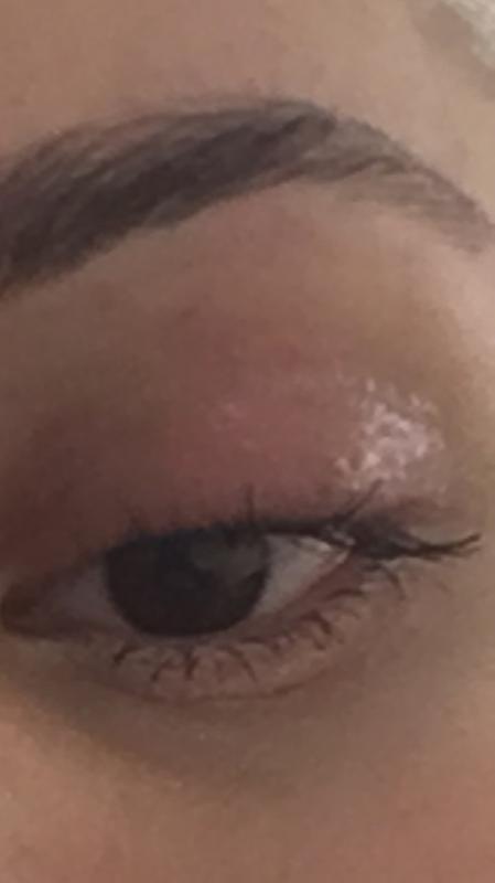 Eye a week after using