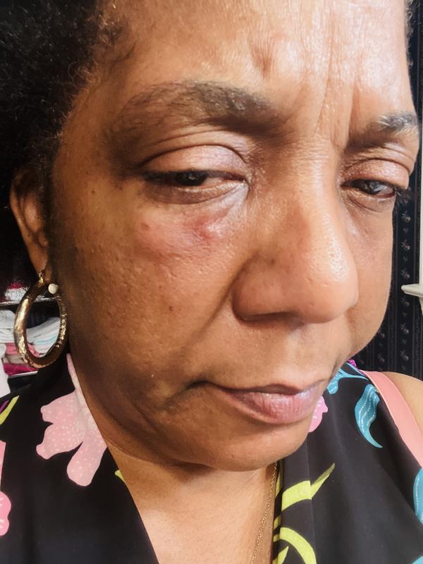 Génifique really broke my skin out and irritated it