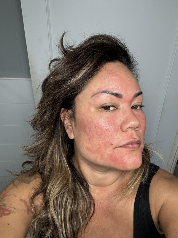 Severe allergy reaction