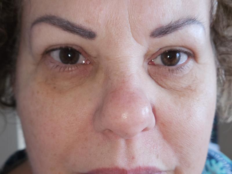 Swollen eyes, one is worse