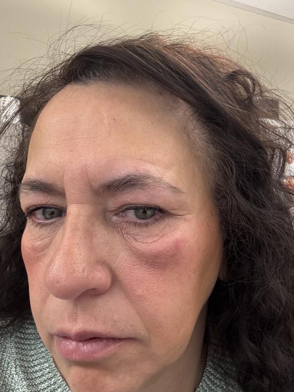 under eye irritation