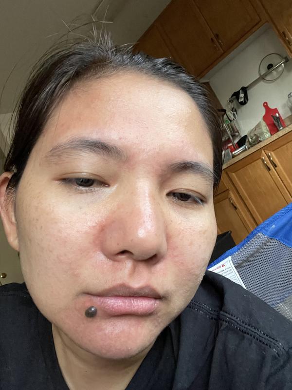 Allergic