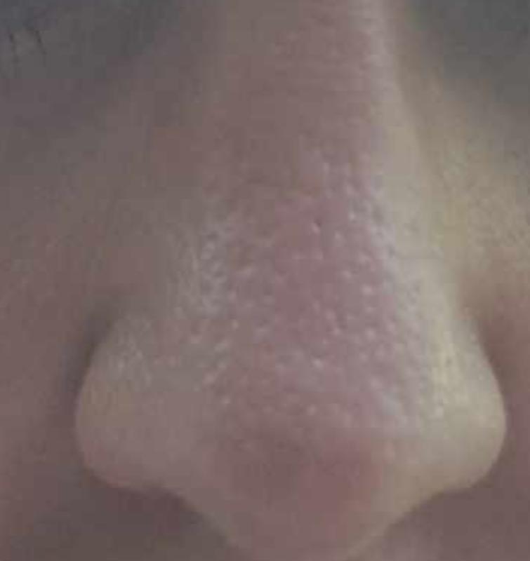 nose pores