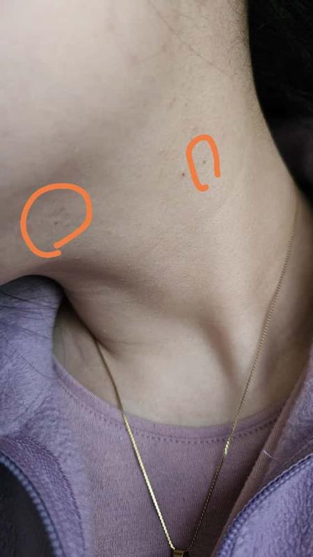 The moles are circled.
