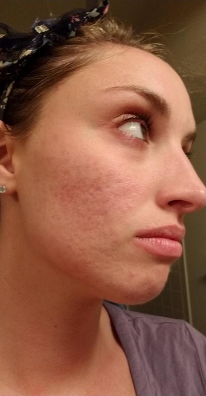 The scaring from 10+ years of acne...taken about 3 years ago