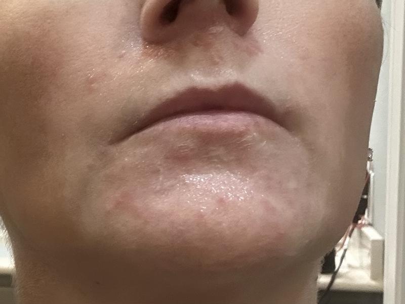 skin outbreak from Lancome Supra Invisible Serum Sunscreen SPF 50