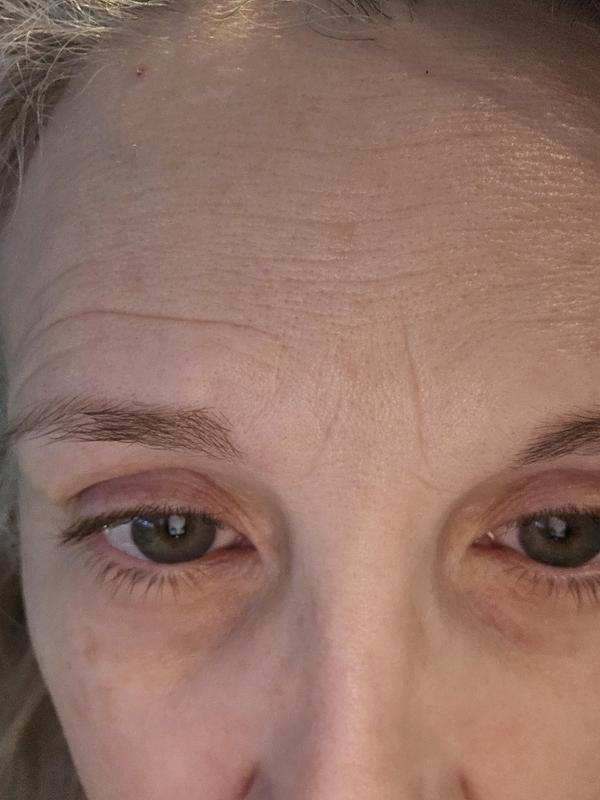 Deep lines between my eyebrows is gone!!!