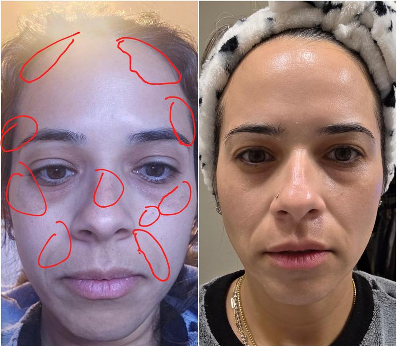 Before lancome and after lancome treatment