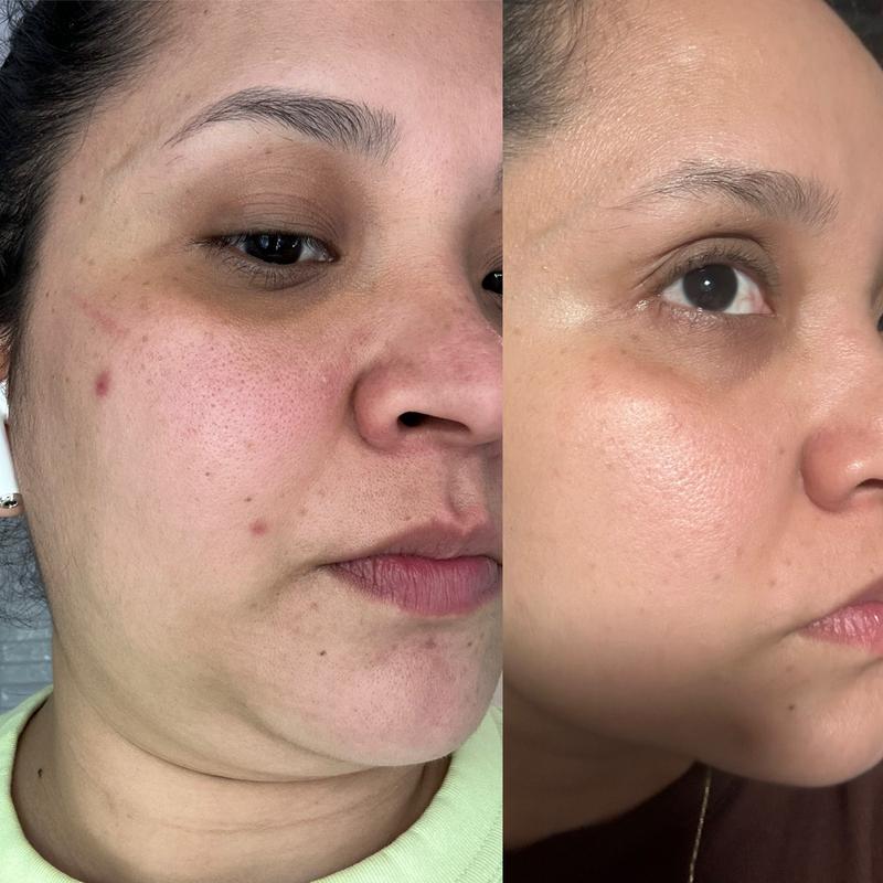 Before and after 2 years using this serum I really love it