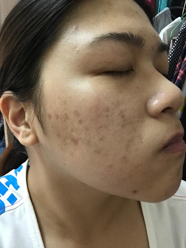 Before use Lancôme my skin was very dark, dry and acne