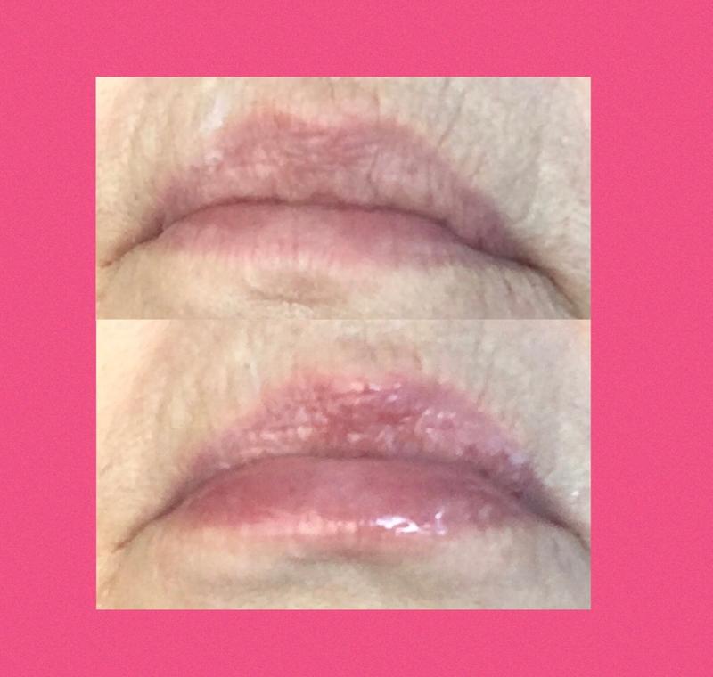 Before & after lips
