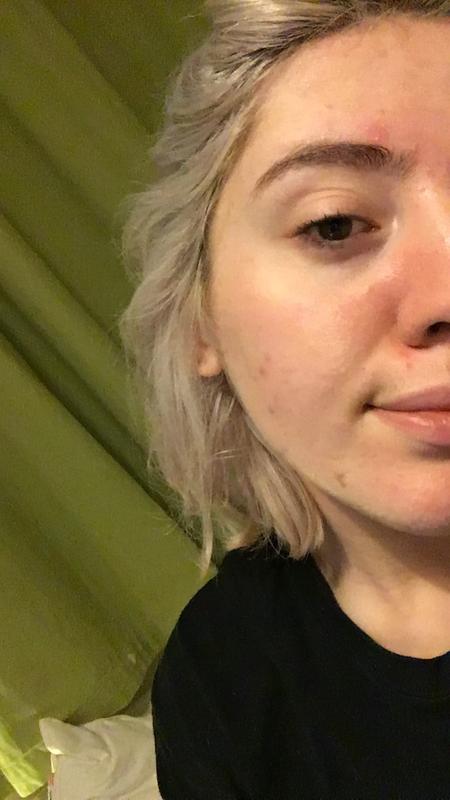 No scarring! Pores aren't completely gone but they are much smaller and with foundation it looks flawless