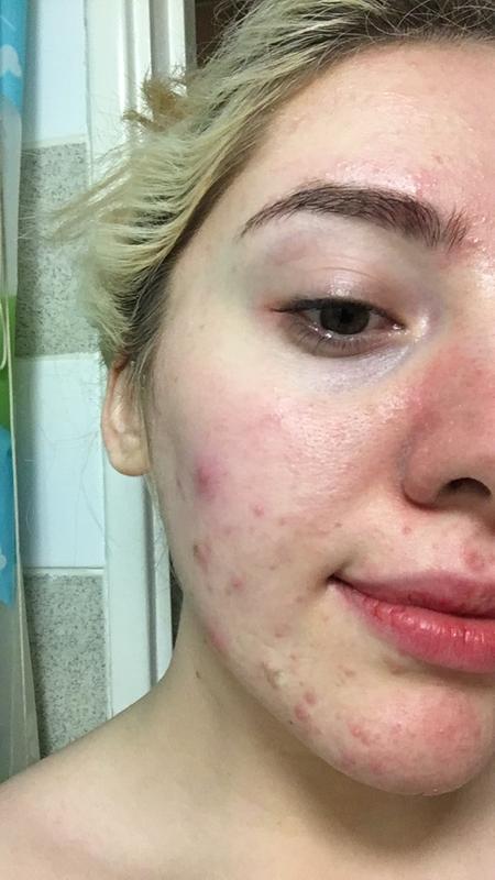 Acne scarring/open pores