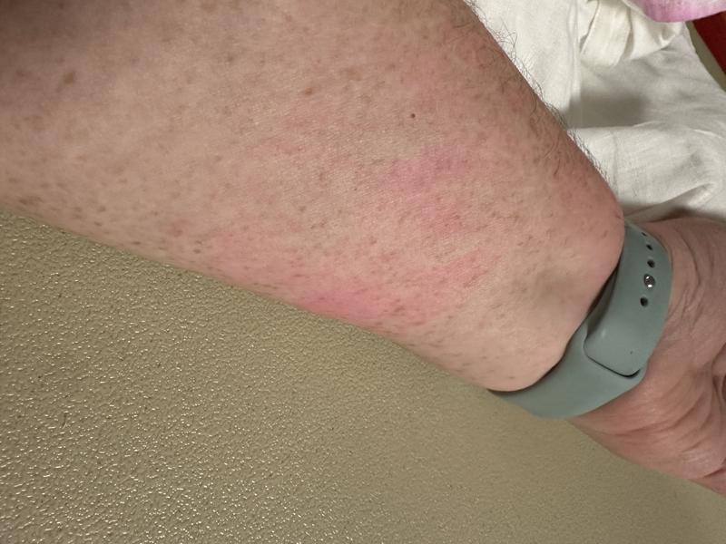 Arm after scrubbing it with soap and water.