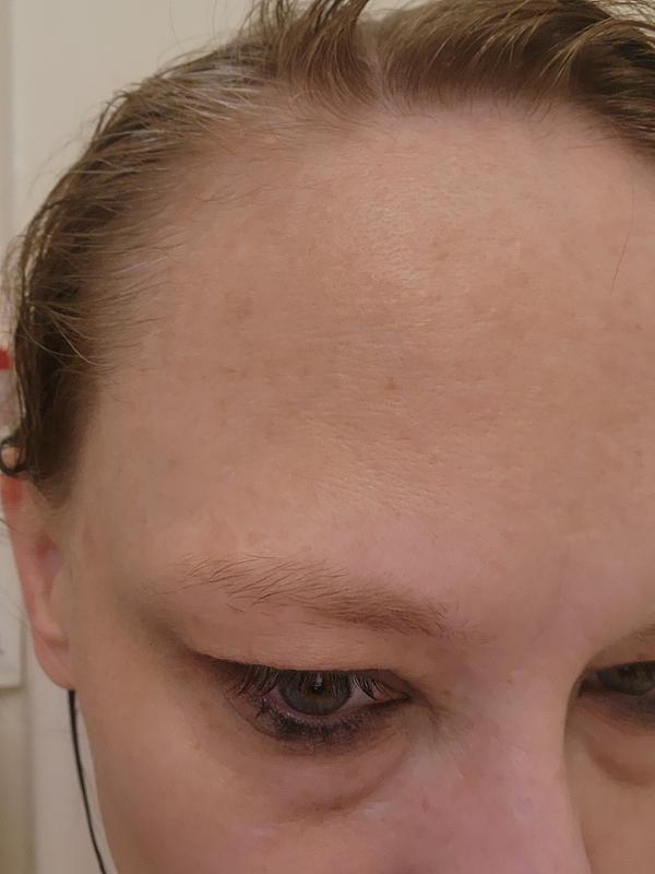 This forehead used to have a dozen pimples