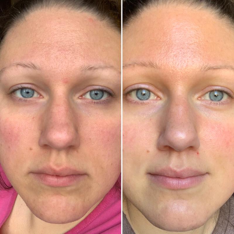 la roche posay cc cream rosacea