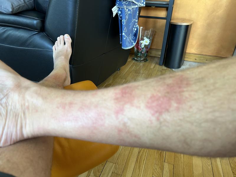 Plaques eczéma liées directement au port des chaussettes levis
