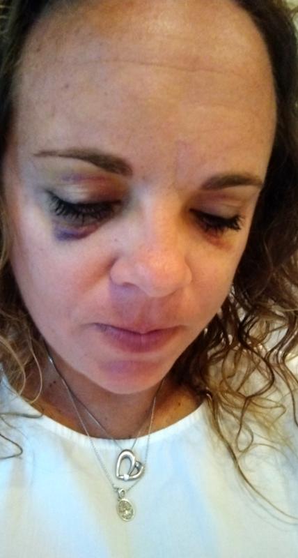 Black eyes from my sunglasses and the sudden impact of the ground!