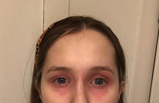 Skin damage
