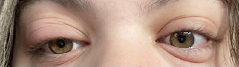 Allergic reaction, swollen, red, itchy