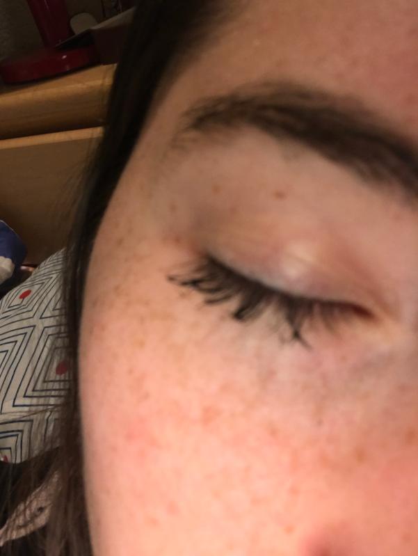Day 3 of unsuccessful removal - imagine how spidery day 1 was!
