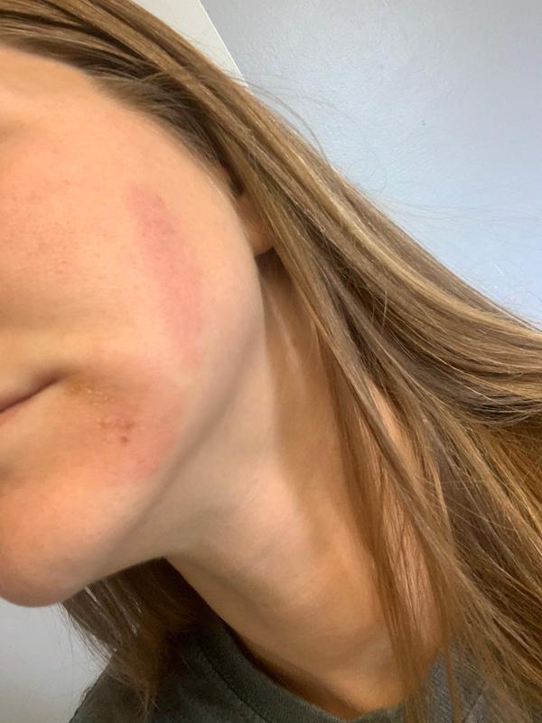 Bad rash, there’s another red spot on the other side of my face too