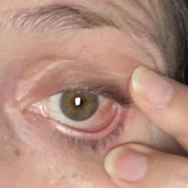 Instant eye irritation and instant migraine