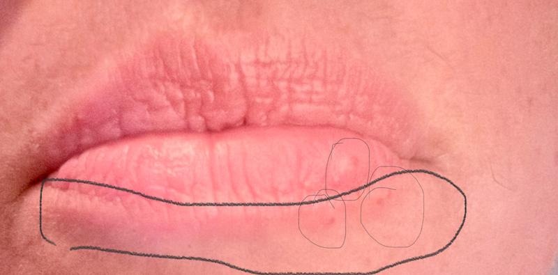Blusters and burned my skin just below lower lip