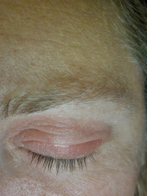 Puffy eyes