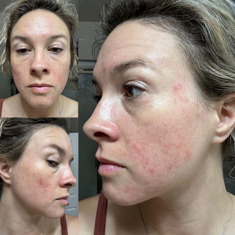 Customer photo for "Helped with my skin"