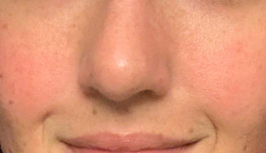 Red face but super clean pores!