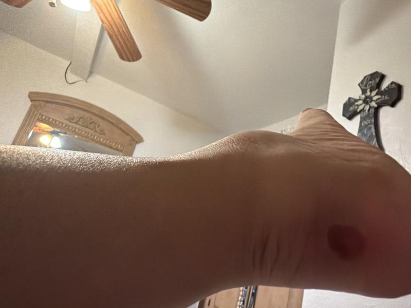 Painful blister