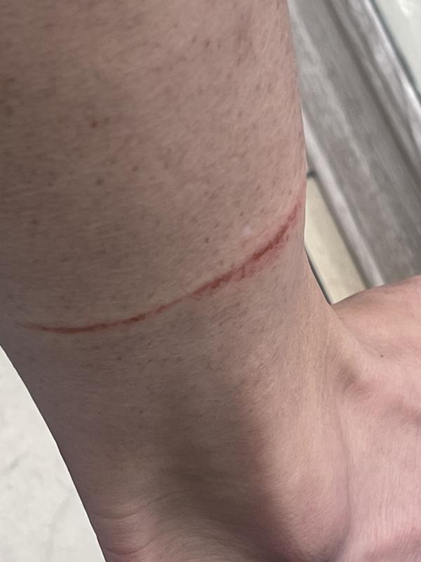 This was right after wearing the shoes although the burns get worse the following day(s) after