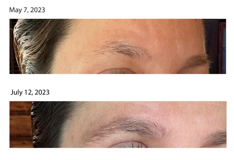 Before/after pics after using for 2 months (2 bottles of serum)