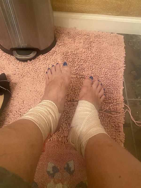 Huge blister and need to place a bundage to be able to walk. I need a refund immediately