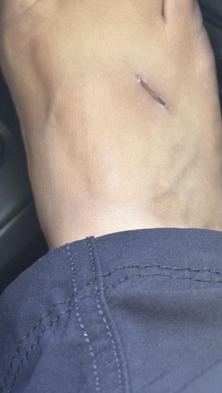 The straps cut me really bad. My foot bleeding and bruised. It’s now healing.