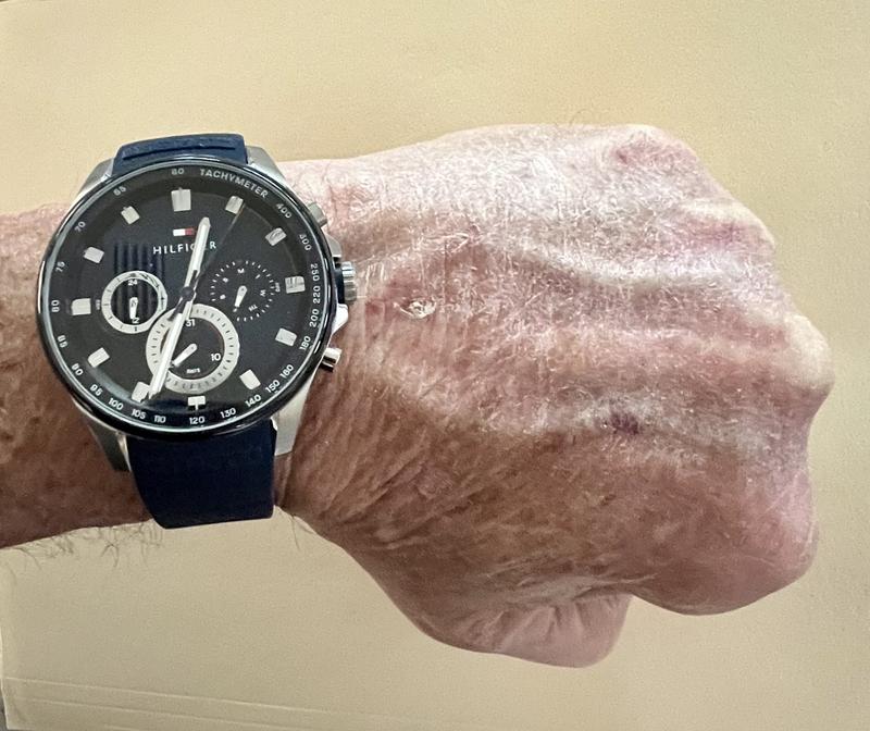 Very nice watch, but notice the sore from the serrated stem.