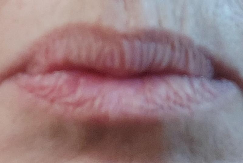 Before lip maximizer.