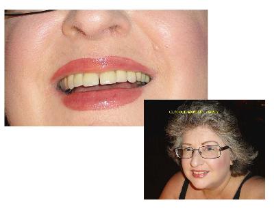 AFTER CLINIQE & SUPERBALM