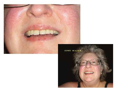 BEFORE CLINIQUE & SUPERBALM