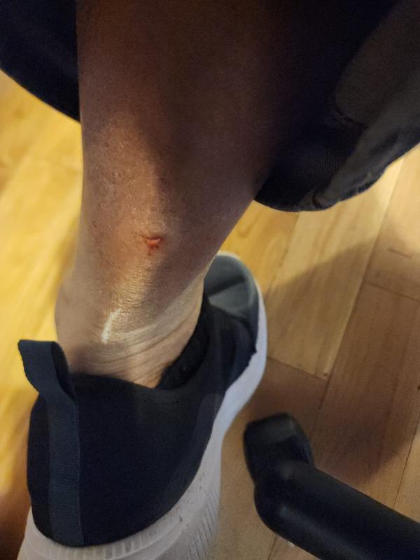 Managed to cut my skin open.