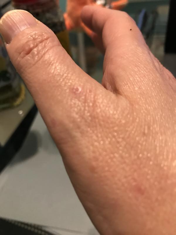 Puncture scars from rotor spikes