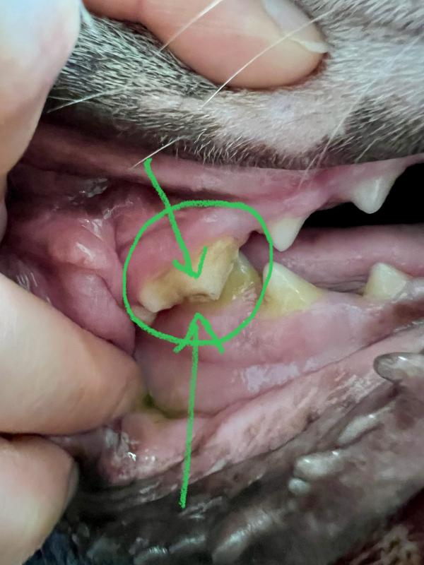 Crown Fracture, Right Upper Premolar #4