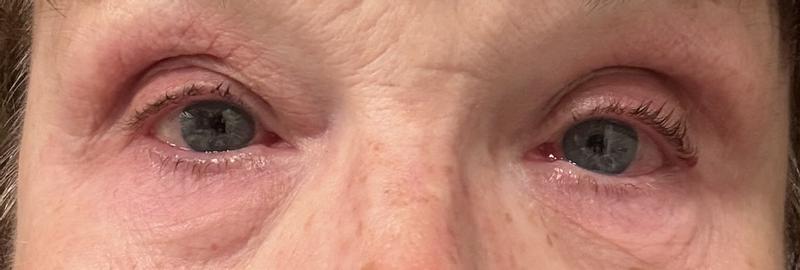 Customer photo for "Eye Rash & Infection — Buyer Beware"