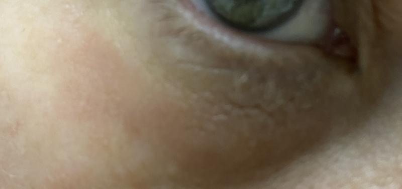 Customer photo for "Eye lids burned"