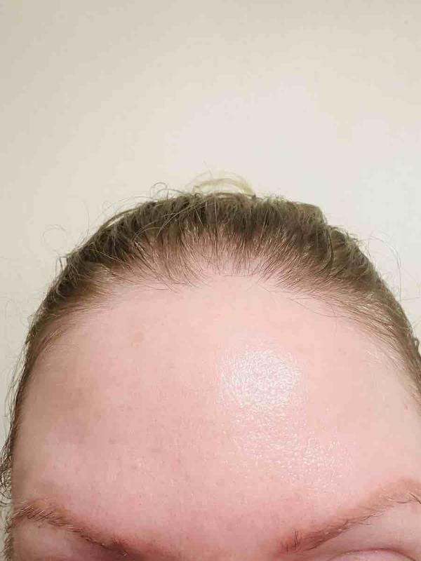 Customer photo for "My Skin Responded Very Well!!"