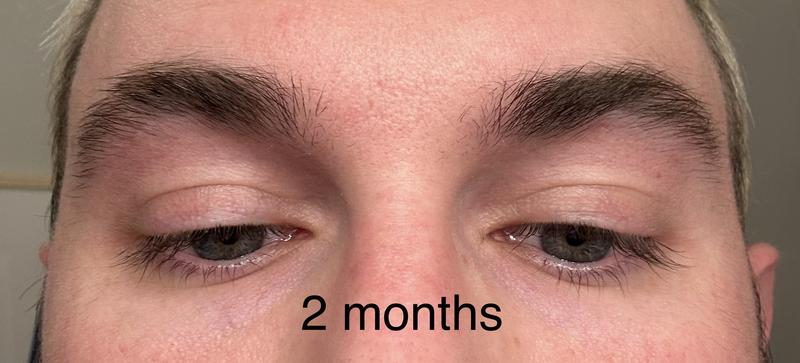 Customer photo for "AMAZING results!  But contains a prostaglandin…"