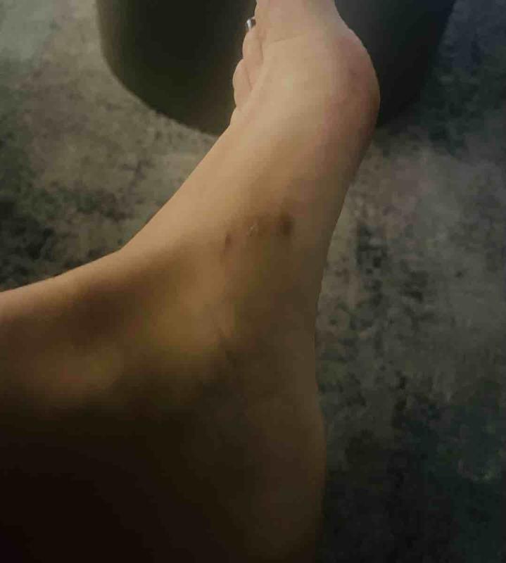 Customer photo for "burned my skin"