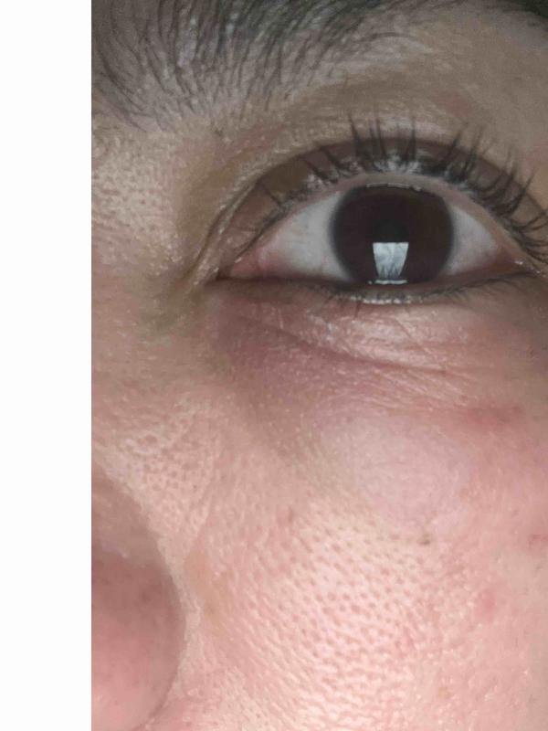 Customer photo for "skin damage/burn"
