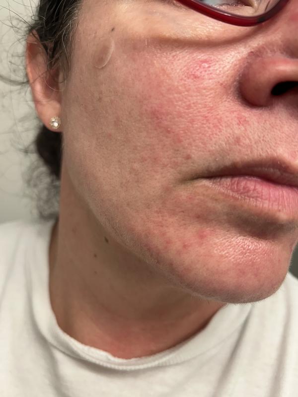Customer photo for "Made me break out horribly"